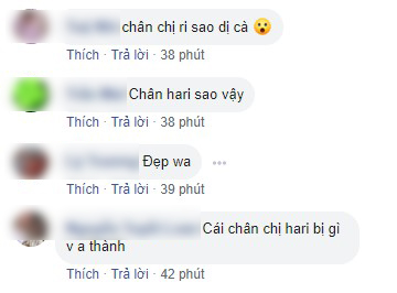 Hari Won v&ocirc; t&igrave;nh để lộ vết bầm t&iacute;m k&igrave; lạ tr&ecirc;n cơ thể, Trấn Th&agrave;nh bị cư d&acirc;n mạng r&eacute;o t&ecirc;n tra hỏi ảnh 3