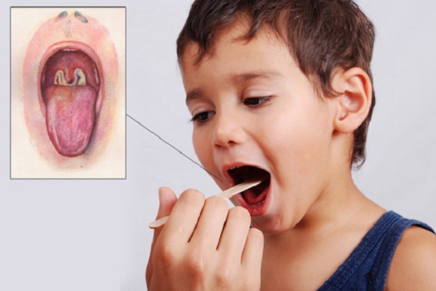 Bạch Hầu là gì? Những điều cần biết về căn bệnh có thể gây tử vong trong 6 ngày Bạch Hầu là gì? Những điều cần biết về căn bệnh có thể gây tử vong trong 6 ngày