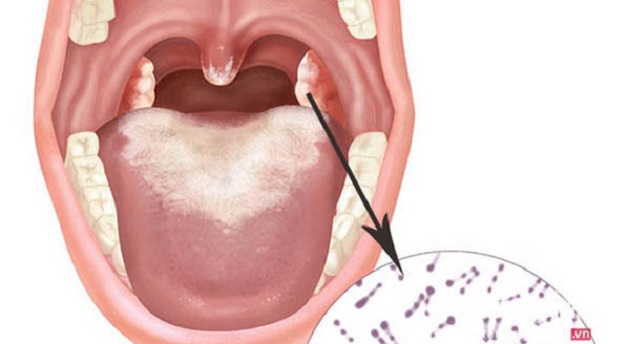 Bạch Hầu là gì? Những điều cần biết về căn bệnh có thể gây tử vong trong 6 ngày Bạch Hầu là gì? Những điều cần biết về căn bệnh có thể gây tử vong trong 6 ngày