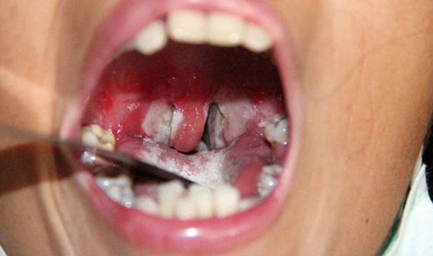 Bạch Hầu là gì? Những điều cần biết về căn bệnh có thể gây tử vong trong 6 ngày Bạch Hầu là gì? Những điều cần biết về căn bệnh có thể gây tử vong trong 6 ngày