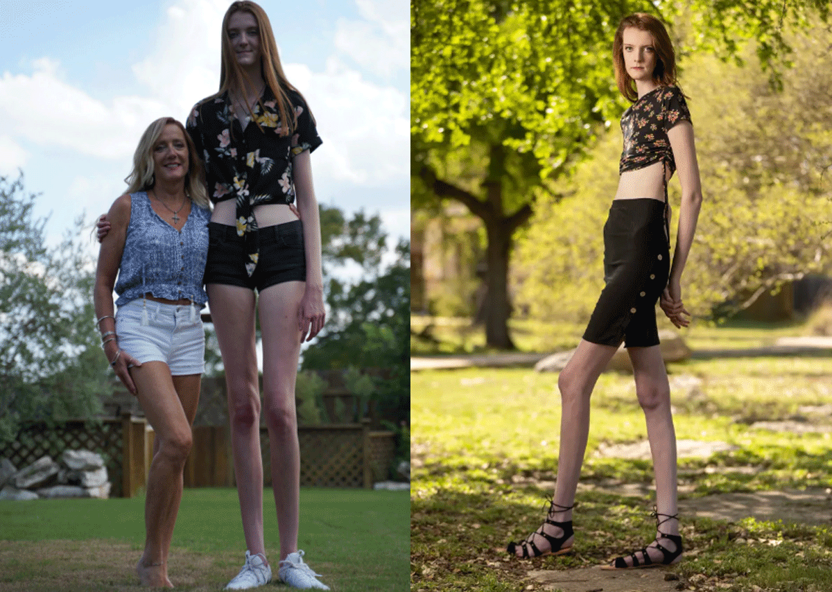 Cô gái 4 năm liên tiếp đạt kỷ lục đôi chân dài nhất thế giới gặp khó khăn trong việc tìm người yêu