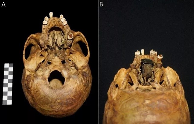 skull-18th-century-medical-prosthesis-11zon-1714468841.jpg