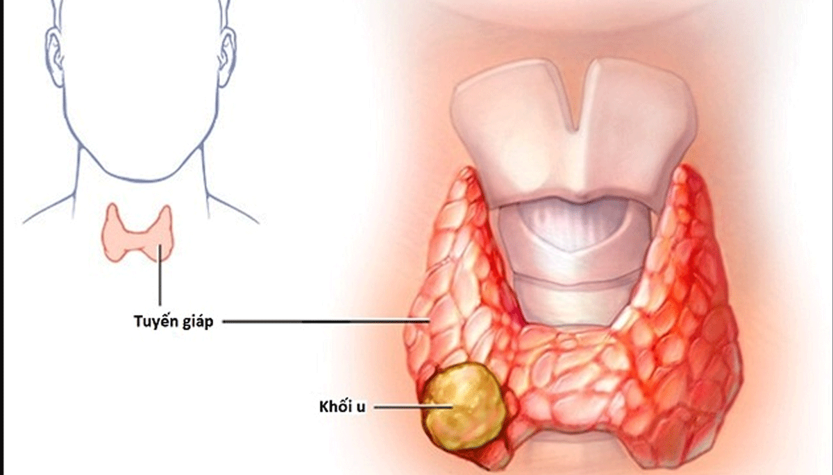 4 dấu hiệu sớm của ung thư tuyến giáp mà nhiều người thường hay bỏ qua?