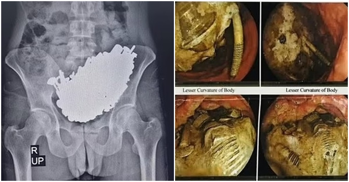 Sốc: Các bác sĩ lấy ra gần 3kg ốc vít, chìa khóa, kim loại từ dạ dày của 1 người đàn ông 37 tuổi