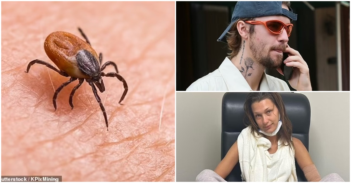 Justin Bieber, Bella Hadid và loạt ngôi sao đình đám mắc bệnh Lyme khó chữa do ve truyền