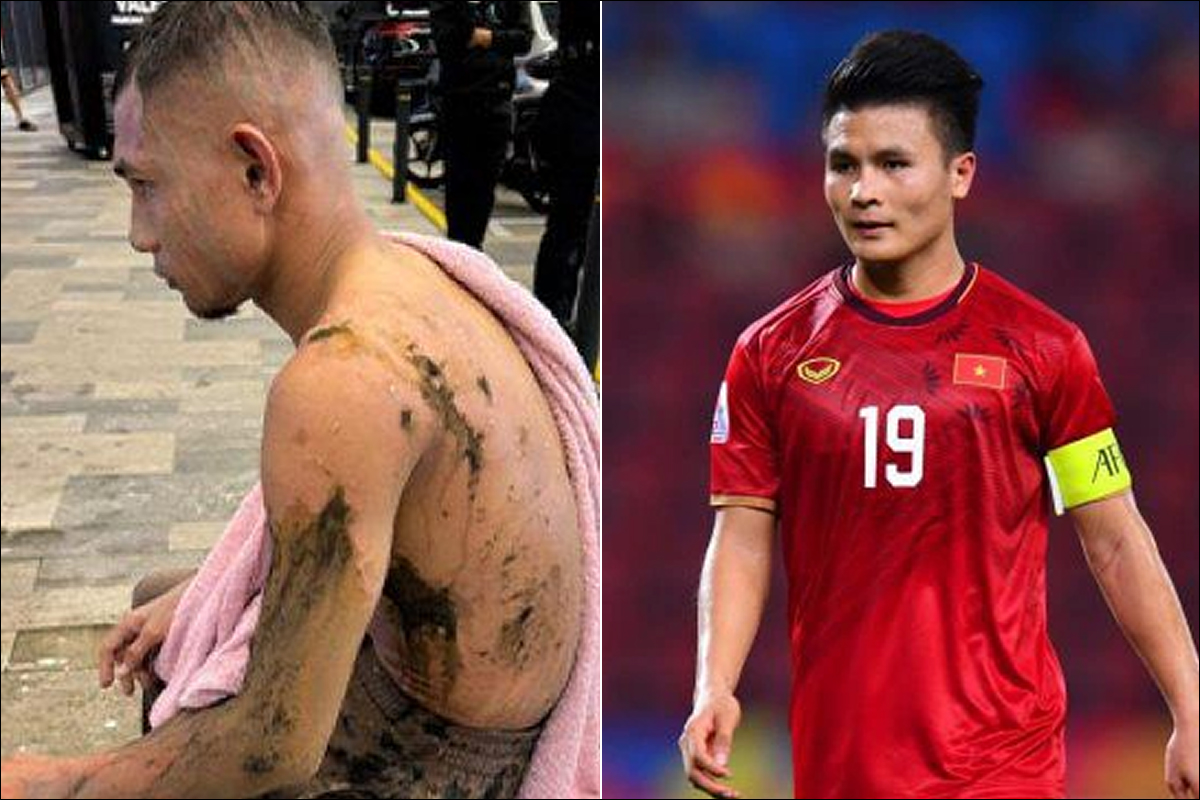 Trước thềm đấu ĐT Việt Nam, \'Ronaldo Malaysia\' tái xuất với diện mạo khó tin sau khi bị tạt axit