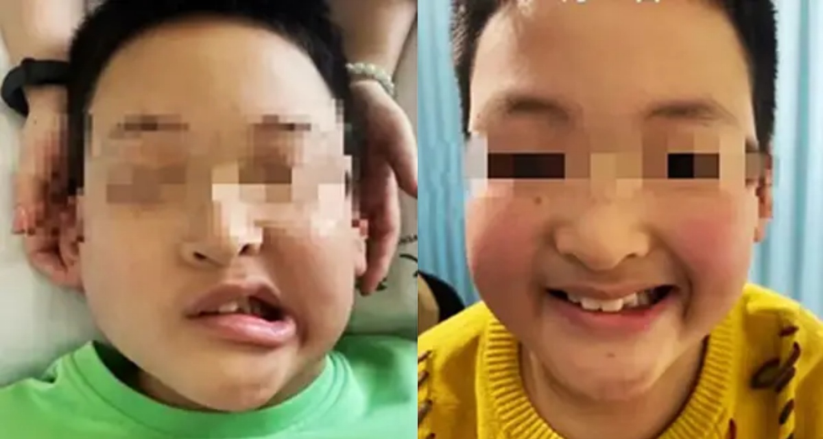 Bé trai 11 tuổi bỗng méo miệng sau một đêm: Bác sĩ tiết lộ nguyên nhân khiến nhiều phụ huynh giật mình