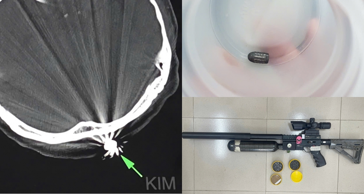 Lời khai của người bắn súng khiến người phụ nữ làm vườn trúng đạn, hé lộ mục đích vác súng ra đường