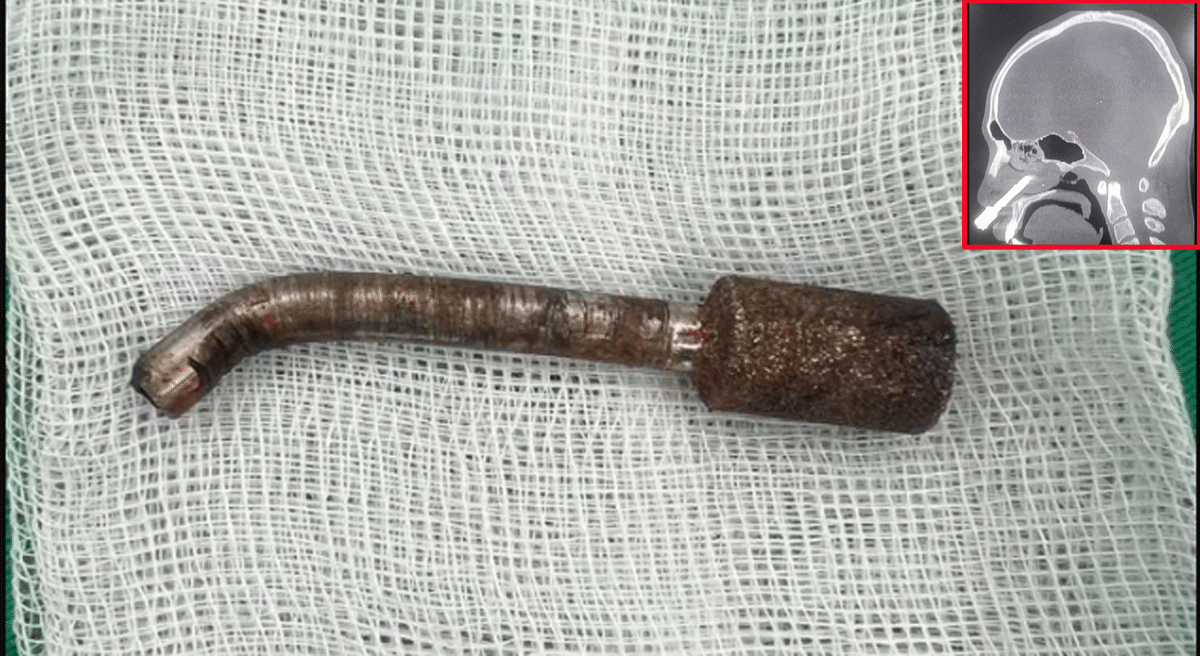 Ám ảnh cảnh nam thanh niên bị mũi khoan dài 8cm đâm xuyên hốc mũi, tình hình hiện tại của bệnh nhân ra sao?