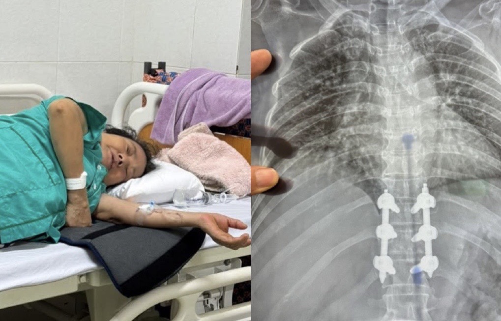 Tìm tài xế xe máy đâm bà lão ở Buôn Ma Thuột rồi bỏ trốn: Nạn nhân gãy 3 đốt sống, chưa có tiền phẫu thuật