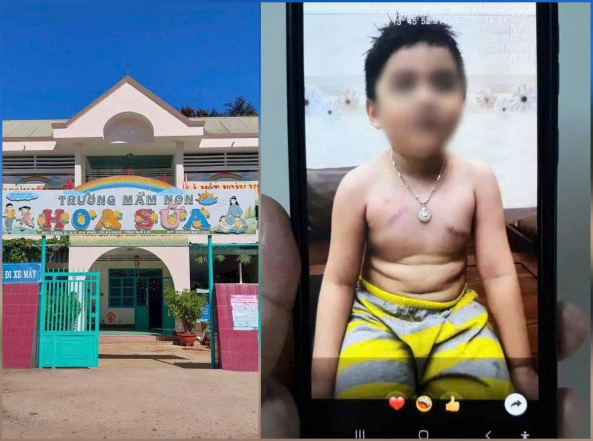 Vụ phụ huynh tố cô giáo \'nhéo trẻ bầm ngực\': Cách giải quyết của nhà trường gây bất ngờ