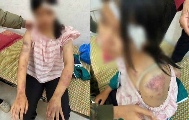 Tình hình sức khỏe của bé gái bị bà nội và người thân bạo hành dã man vì nghi ăn trộm tiền