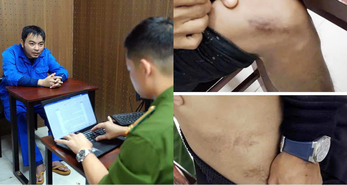 Rùng mình quá trình cựu nhân viên y tế tự đục vỡ xương để trục lợi bảo hiểm, hành vi quá man rợ