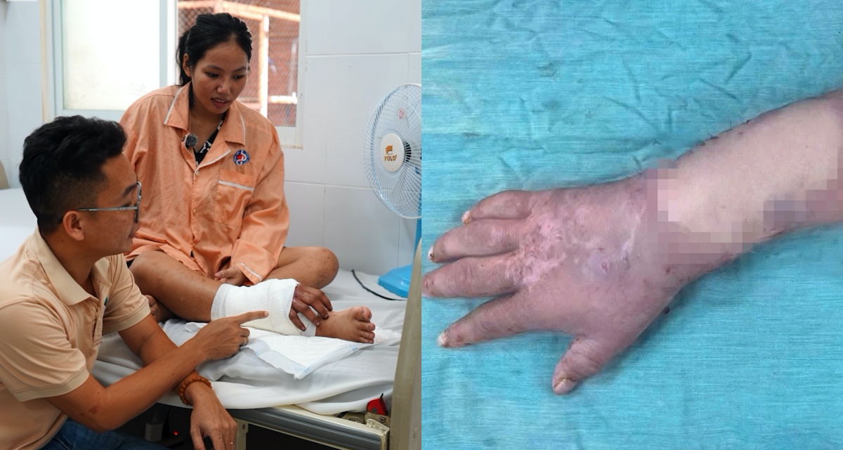 Hành trình phẫu thuật nối lại tay đứt lìa sau ghép tạm vào chân cho thai phụ: Bác sĩ thông tin tình trạng hiện tại