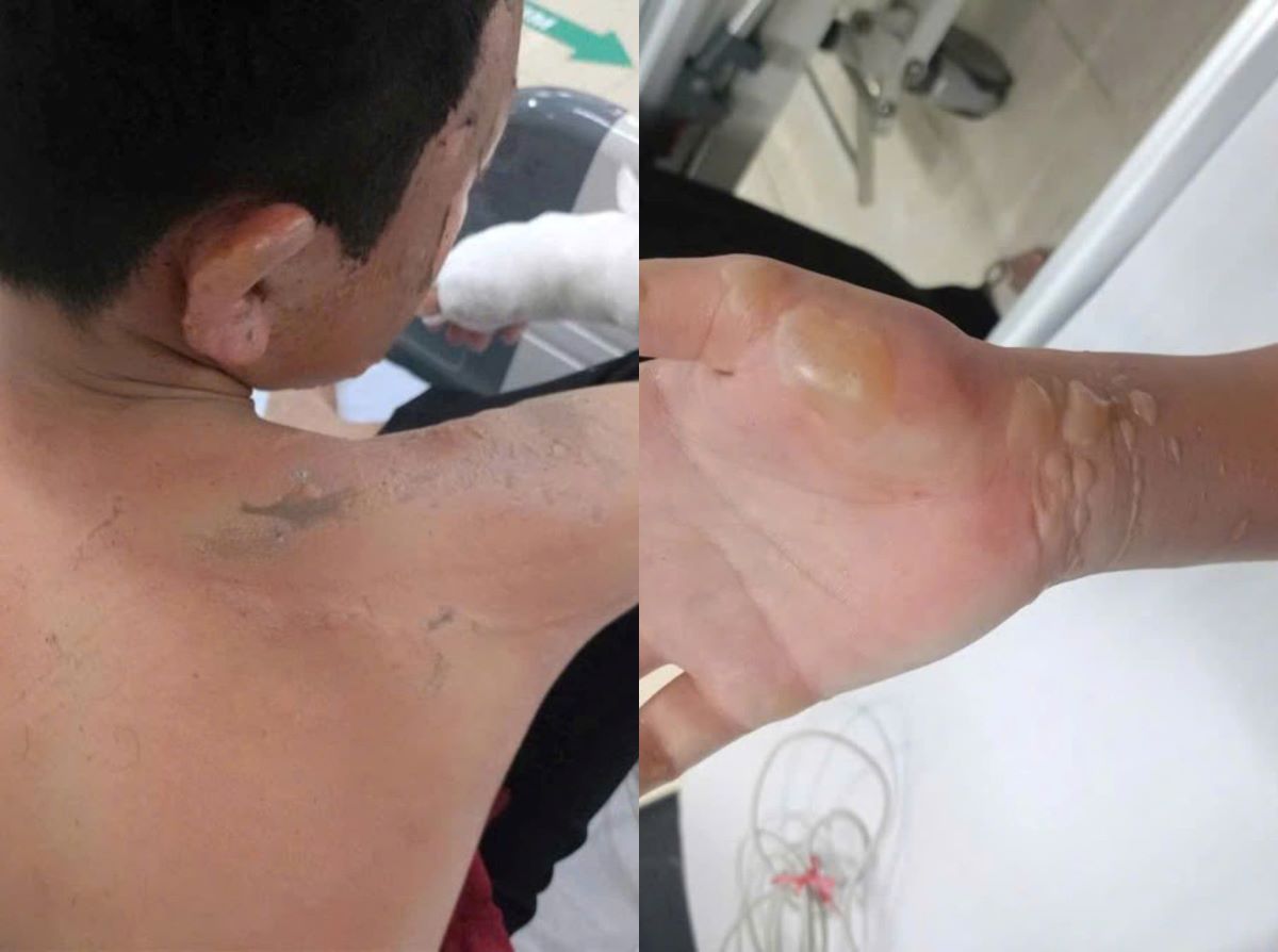 Ninh Bình: Lén đốt pháo, bé trai 12 tuổi gặp thảm kịch khiến cả gia đình bàng hoàng