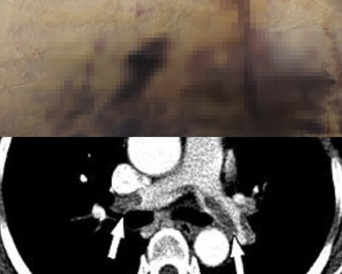 Sau 48 giờ phẫu thuật hút mỡ và nâng ngực, một nữ Việt kiều 60 tuổi tử vong: Hé lộ nguyên nhân