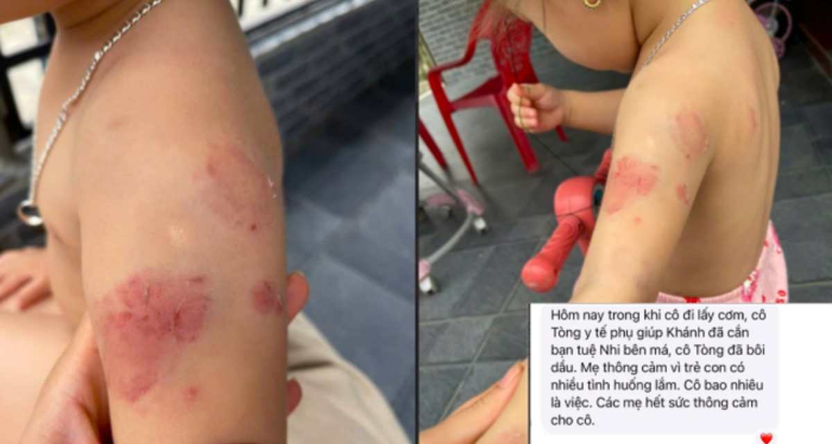 B&eacute; hơn 2 tuổi chi ch&iacute;t vết bầm t&iacute;m sau giờ học, lời giải th&iacute;ch g&acirc;y tranh c&atilde;i từ gi&aacute;o vi&ecirc;n mầm non v&agrave; nh&agrave; trường