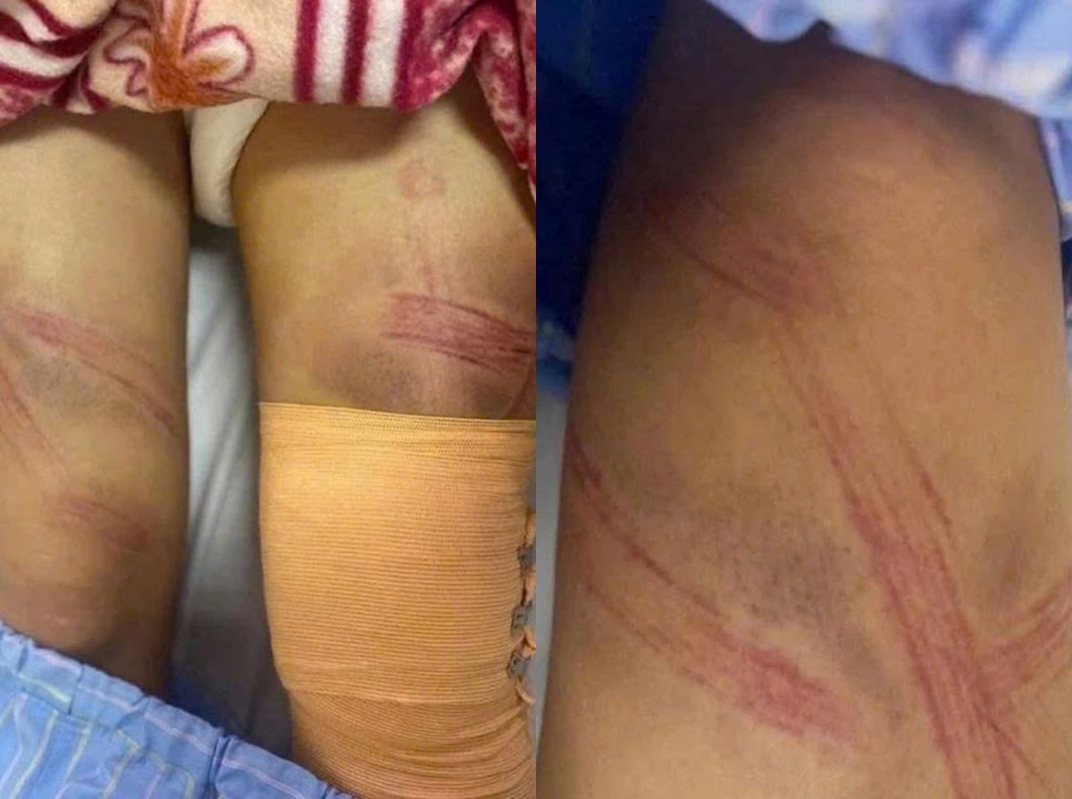 Th&ocirc;ng tin n&oacute;ng vụ nữ sinh lớp 7 nhập viện với nhiều vết bầm: Bất ngờ với lời khai của người bố