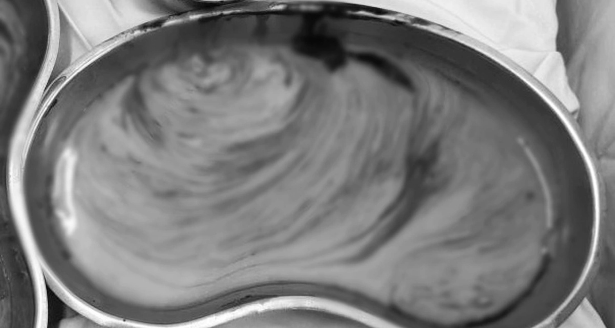 Người phụ nữ ti&ecirc;m filler v&ugrave;ng m&ocirc;ng gặp biến chứng sau nhiều năm, b&aacute;c sĩ h&uacute;t 3 l&iacute;t dịch mủ, t&igrave;nh trạng hiện tại &aacute;m ảnh