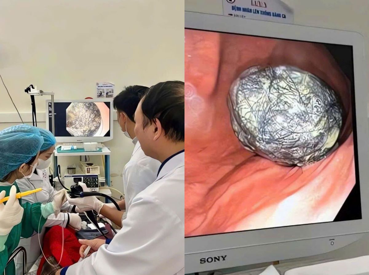 Quảng Ninh: B&eacute; g&aacute;i 5 tuổi suy dinh dưỡng nặng, chỉ 13kg, b&aacute;c sĩ ph&aacute;t hiện b&uacute;i t&oacute;c lớn trong dạ d&agrave;y