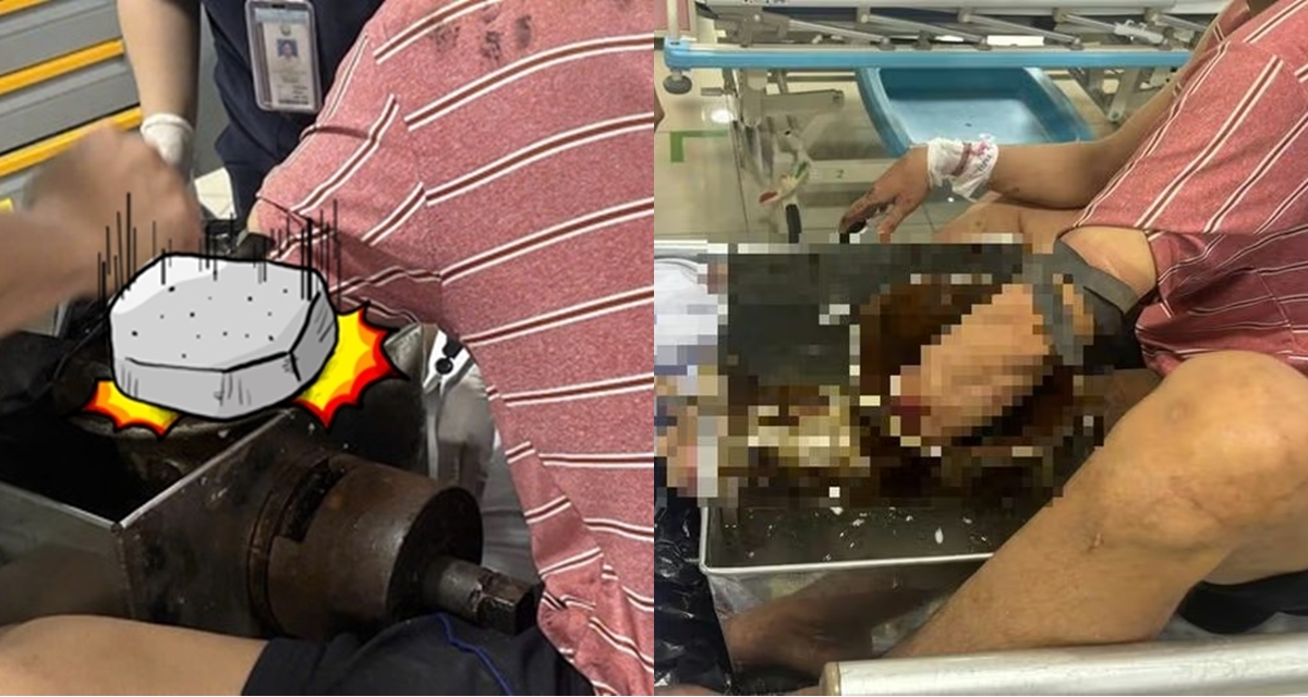 TP.HCM: Nam c&ocirc;ng nh&acirc;n bị cuốn cả c&aacute;nh tay v&agrave;o m&aacute;y xay thịt, &aacute;m ảnh t&igrave;nh trạng khi nhập viện cấp cứu