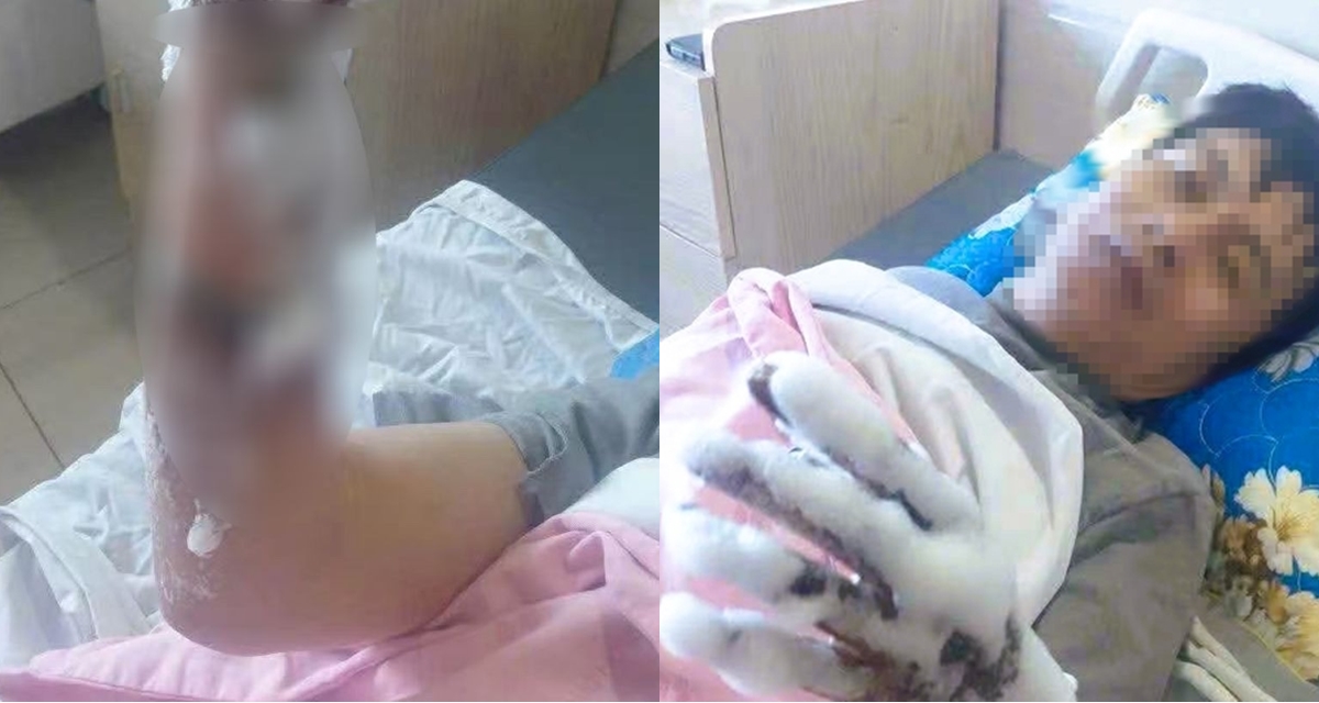 Thanh H&oacute;a: Nam c&ocirc;ng nh&acirc;n bỏng nặng 2 tay v&igrave; bị ph&oacute;ng điện, ng&agrave;nh chức năng c&ocirc;ng bố nguy&ecirc;n nh&acirc;n