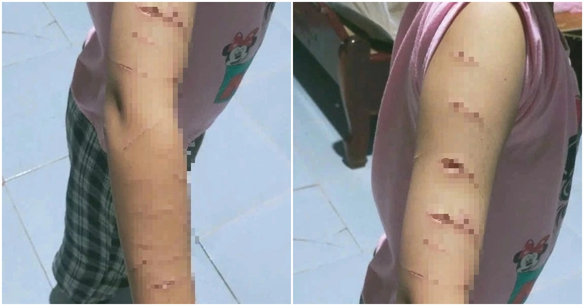 Gi&aacute;o vi&ecirc;n hoảng hốt ph&aacute;t hiện vết rạch chằng chịt tr&ecirc;n tay của 1 học sinh lớp 5, sững sờ danh t&iacute;nh  người rạch