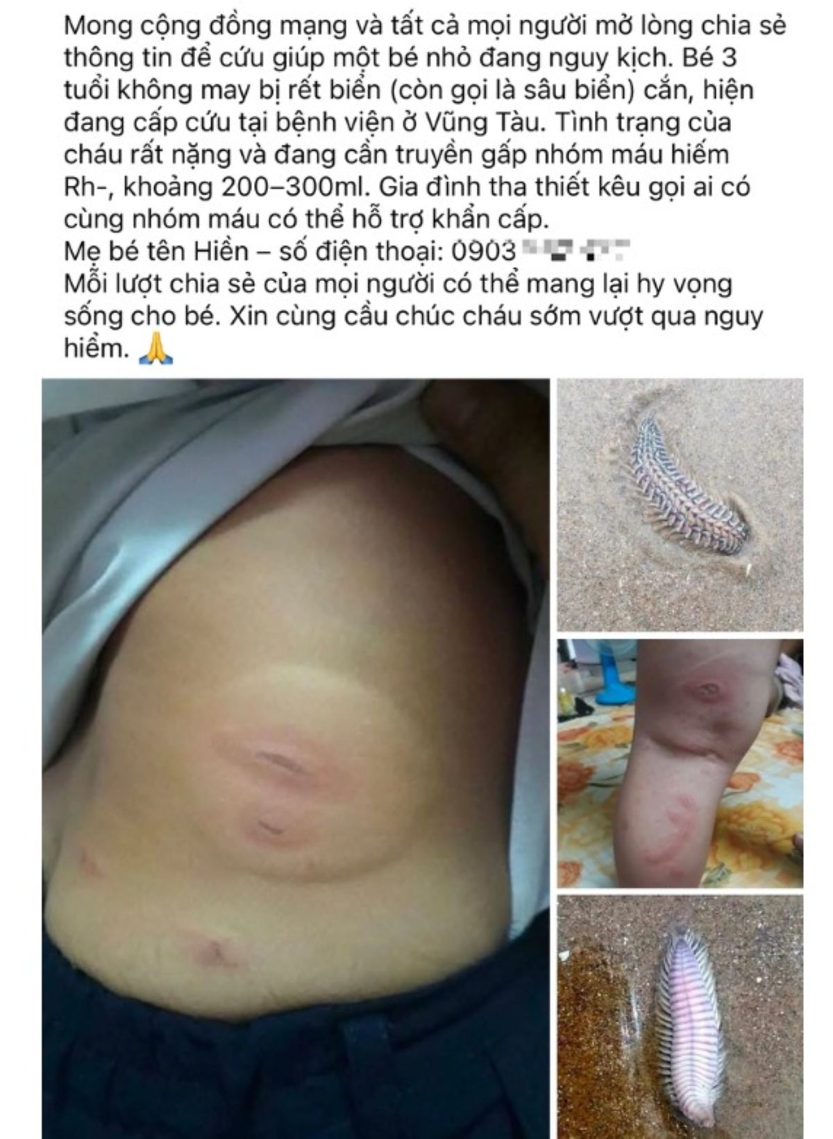 Sự thật kh&ocirc;ng ngờ đằng sau m&agrave;n kịch k&ecirc;u gọi cứu trợ m&aacute;u khẩn cấp cho ch&aacute;u b&eacute; 3 tuổi bị s&acirc;u biển cắn