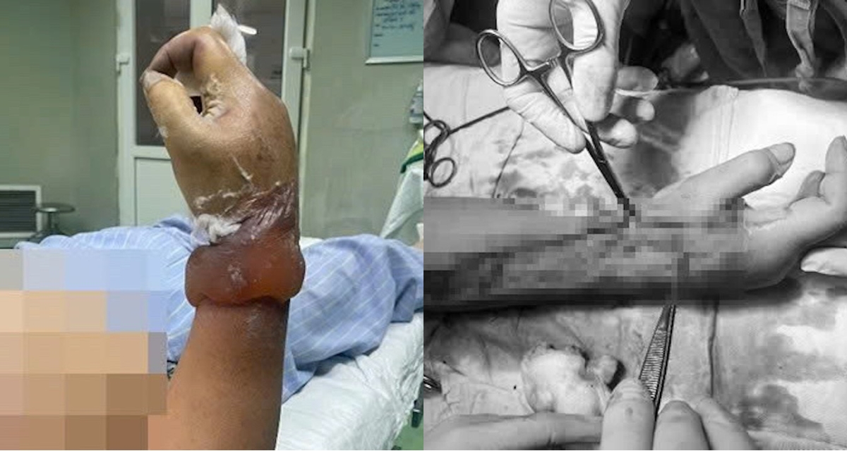 L&yacute; do 2 vợ chồng ở Nghệ An bị điện giật khi dựng c&acirc;y n&ecirc;u đ&oacute;n Tết, 1 người nguy cơ cao cụt cẳng tay