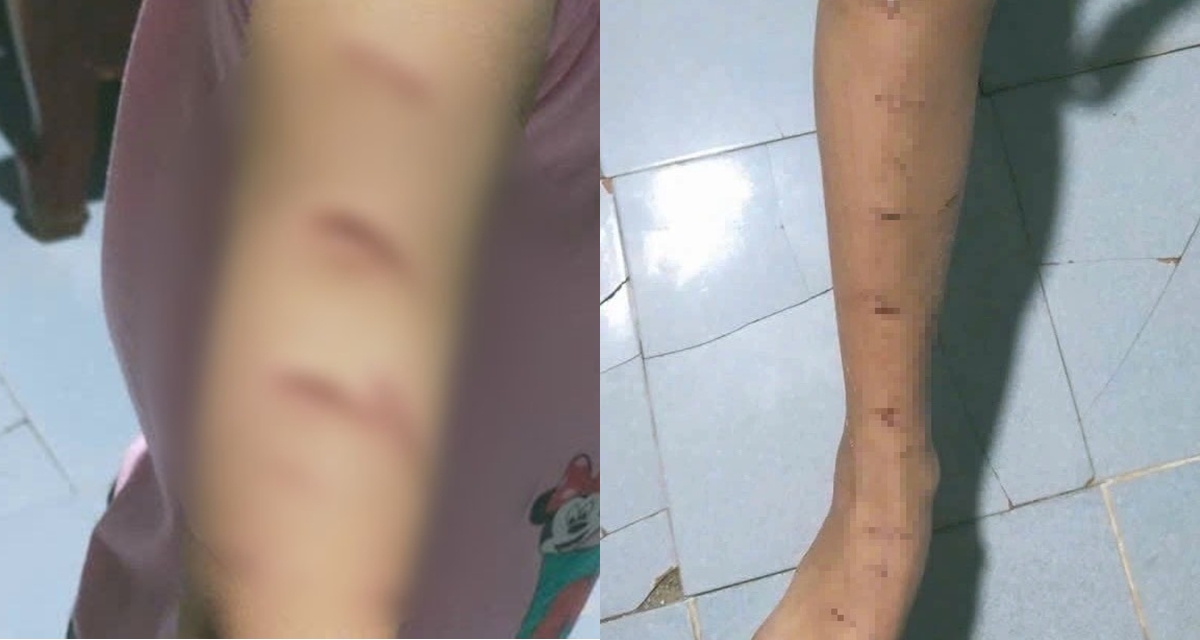Lời khai người chị họ d&ugrave;ng dao rạch khắp người b&eacute; g&aacute;i lớp 5, gia đ&igrave;nh đưa ra hướng giải quyết
