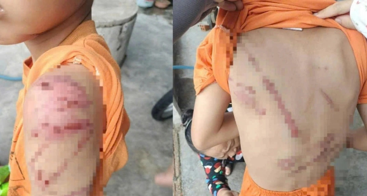 Chi ch&iacute;t vết bầm tr&ecirc;n người b&eacute; trai 10 tuổi ở Đắk Lắk: H&eacute; lộ sự thật ph&iacute;a sau, li&ecirc;n quan đến bố ruột