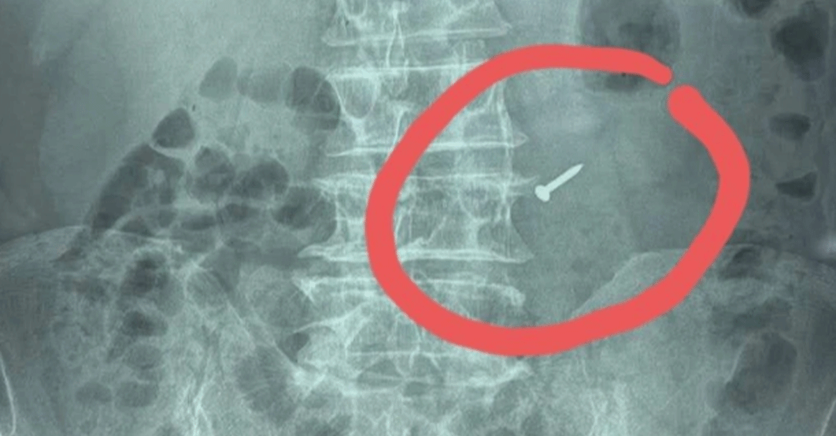 Người đ&agrave;n &ocirc;ng nuốt phải chiếc đinh sắt nhọn v&igrave; th&oacute;i quen kh&oacute; bỏ, gia đ&igrave;nh sững sờ khi ph&aacute;t hiện