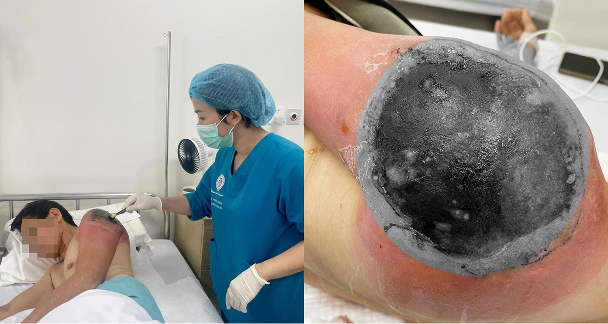 Người đ&agrave;n &ocirc;ng su&yacute;t mất cả c&aacute;nh tay v&igrave; đắp l&aacute; chữa chấn thương theo mẹo d&acirc;n gian