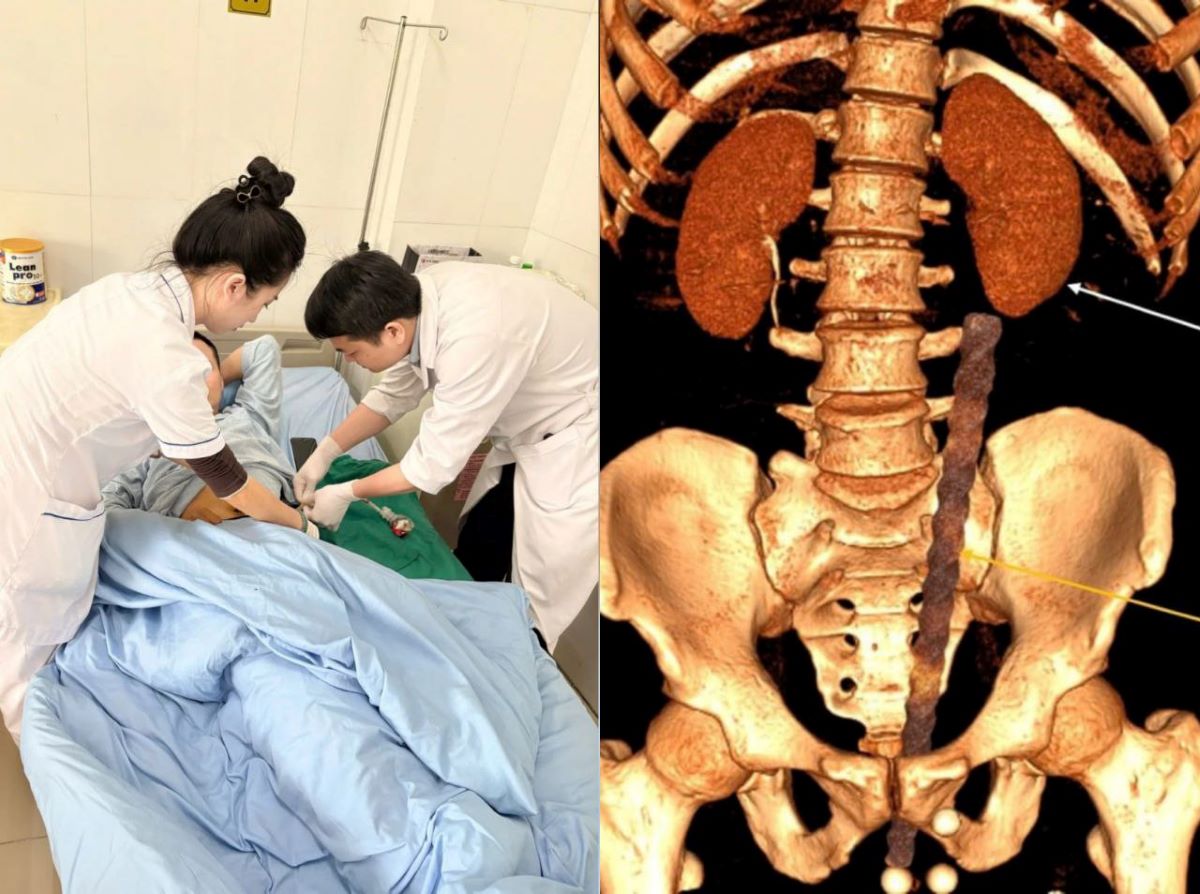 Quảng Ninh: Cấp cứu ca tai nạn hy hữu bị cọc sắt xuy&ecirc;n thấu ổ bụng s&acirc;u 30cm, hiện sức khỏe ra sao?