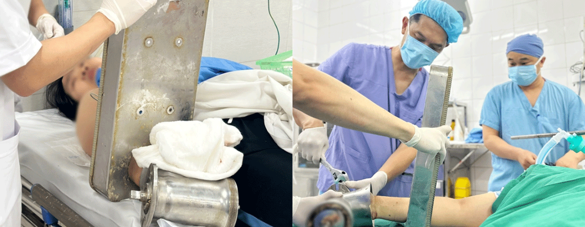 B&agrave;n tay người phụ nữ cuốn chặt v&agrave;o m&aacute;y xay: B&aacute;c sĩ c&oacute; quyết định khẩn để bảo vệ t&iacute;nh mạng bệnh nh&acirc;n