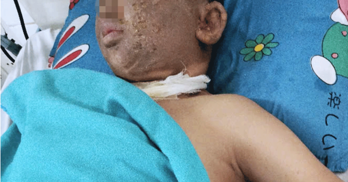 TP.HCM: Nam thanh ni&ecirc;n mất một mắt sau khi thực hiện tục lệ quen thuộc ng&agrave;y Tết, t&igrave;nh h&igrave;nh nạn nh&acirc;n