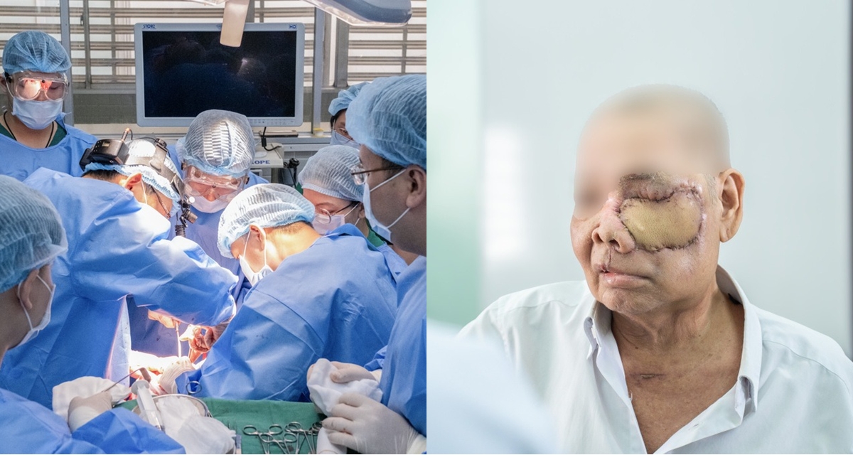 8 khoa v&agrave;o cuộc l&agrave;m n&ecirc;n cuộc đại phẫu &rsquo;10 tiếng&rsquo; chưa từng c&oacute; ở Bệnh viện Chợ Rẫy, cứu bệnh nh&acirc;n ung thư hốc mũi