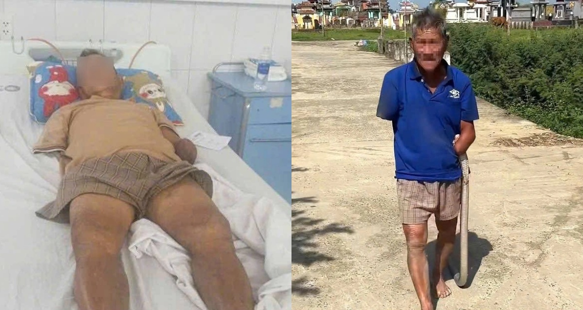 &Ocirc;ng l&atilde;o cụt tay kẹp rắn hổ mang sau khi bị cắn ở Đ&agrave; Nẵng, bệnh viện th&ocirc;ng b&aacute;o t&igrave;nh trạng sức khỏe v&agrave; chi ph&iacute; điều trị