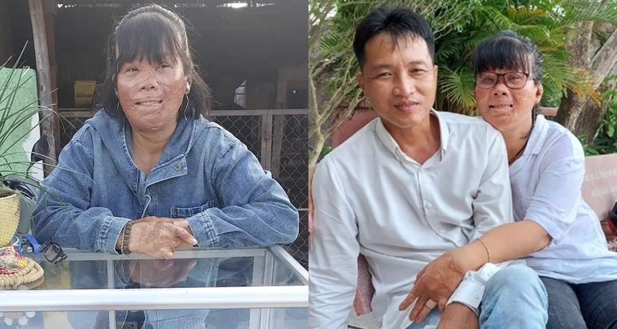 Người phụ nữ bỏng 78% cơ thể v&igrave; cứu con ri&ecirc;ng của bạn trai nhưng rồi lại bị bỏ rơi, cuộc sống hiện ra sao?