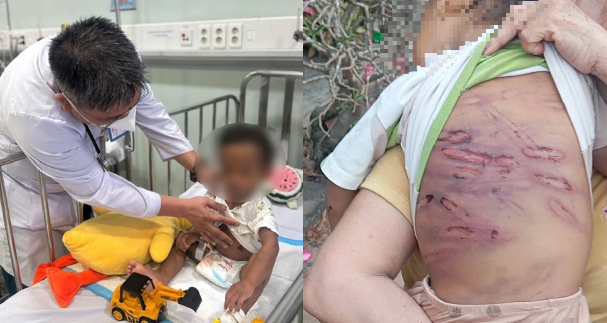 B&eacute; trai 2 tuổi trong vụ bạo h&agrave;nh ở TP.HCM qua cơn nguy kịch, h&eacute; lộ t&igrave;nh trạng sức khỏe sau điều trị
