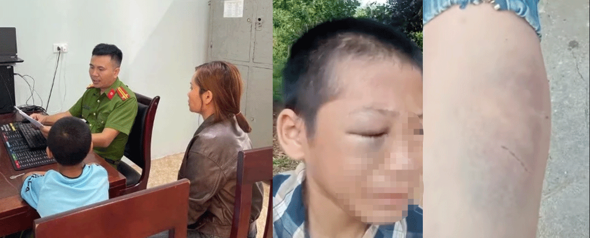 B&eacute; trai lớp 6 kh&oacute;c cầu cứu c&ocirc; ruột v&igrave; bị bố v&agrave; mẹ kế bạo h&agrave;nh: T&igrave;nh h&igrave;nh ch&aacute;u b&eacute;, phản ứng mẹ ruột khi biết tin