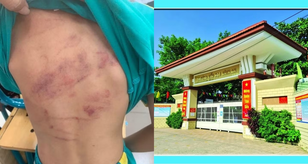 TPHCM: Học sinh lớp 1 bị bạn đ&aacute;nh hội đồng chỉ v&igrave; c&aacute;i b&aacute;nh, bất ngờ c&aacute;ch giải quyết của trường