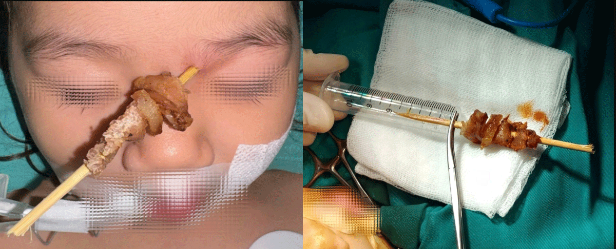 Nguy&ecirc;n nh&acirc;n b&eacute; g&aacute;i hơn 2 tuổi bị que xi&ecirc;n thịt nướng đ&acirc;m v&agrave;o hốc mắt, t&igrave;nh h&igrave;nh sức khỏe của b&eacute;?