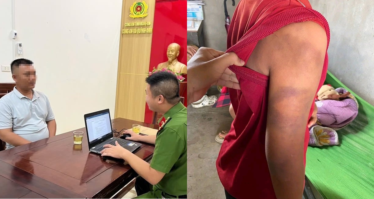 Diễn biến mới vụ mẹ cầu cứu nghi con trai bị bố ruột bạo h&agrave;nh sau khi ly h&ocirc;n ở Nghệ An
