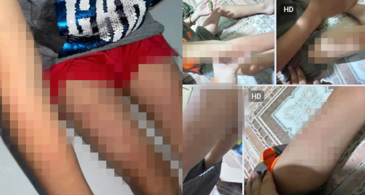 B&eacute; trai 7 tuổi nghi bị đ&aacute;nh tại nh&agrave; giữ trẻ ở Kh&aacute;nh H&ograve;a: Người đầy vết bầm t&iacute;m, gia đ&igrave;nh cầu cứu
