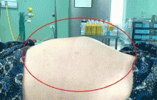 Cô gái 18 tuổi ở Nghệ An có khối u buồng trứng bằng quả bóng đá nhưng lầm tưởng đang mang thai