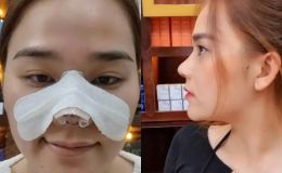 Được Ngô Kiến Huy tài trợ tiền làm răng, Thánh Sún vẫn bỏ thêm tiền trùng tu nhan sắc