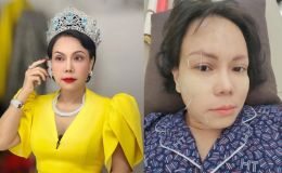 Việt Hương bị méo 1 bên mặt phải châm cứu điều trị, nguyên nhân khiến dân tình xót xa