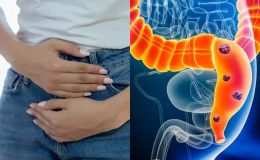 Phát hiện nguyên nhân gây ra 1 căn bệnh ung thư đang gia tăng ở người trẻ