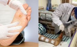 Người đàn ông phải cắt bỏ cả bàn chân chỉ vì thói quen sai lầm khi đi giày, nhiều người Việt Nam mắc phải